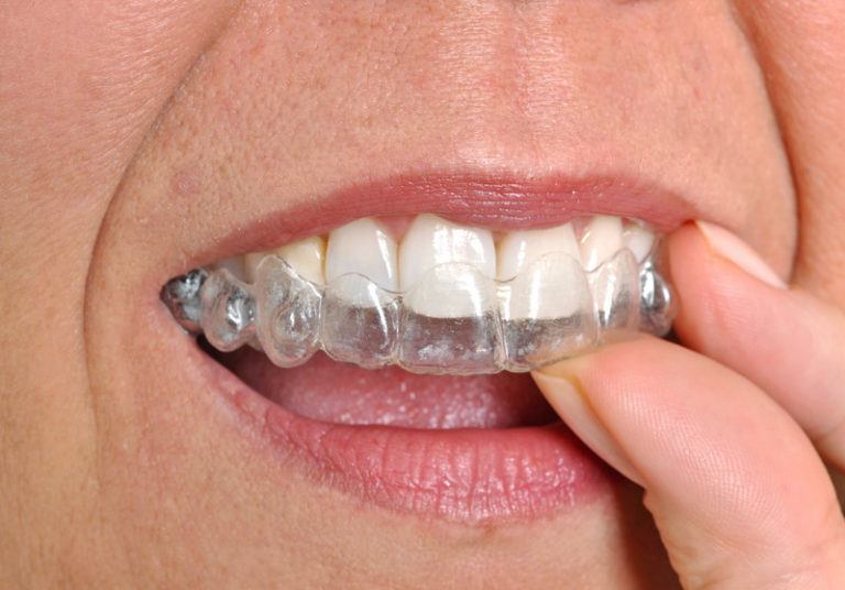 Top Ten Orthodontic Affiliate Programs That Brace Up Affiliate