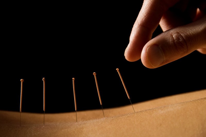 This photo shows a woman's back with five acupuncture needles in it, below a hand that appears to be reaching for the needles, representing the best alternative medicine affiliate programs.