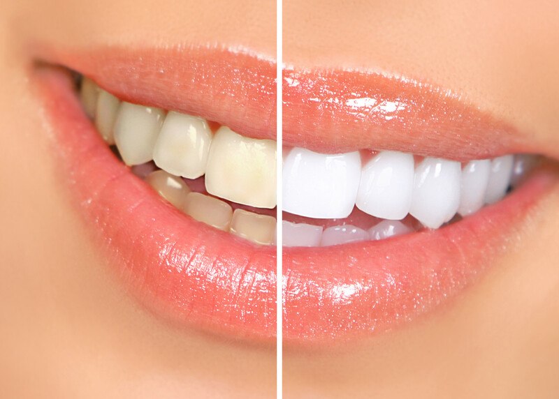 This photo shows a closeup of a woman's smiling mouth, with slightly yellow teeth on the left side of the photo and whitened teeth on the right side of the photo, representing the best teeth whitening affiliate programs.